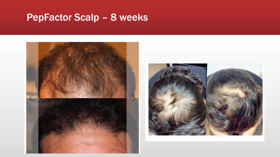 PepFactor Scalp images